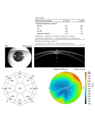 Equipment-Pachymetry-Result
